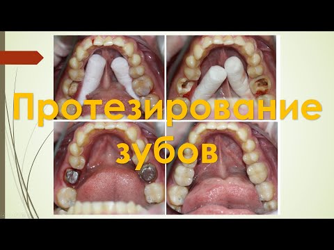 Секреты Стоматологии - Глава 4. Протезирование.(Коронки, Виниры)