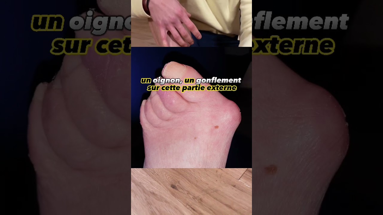 MIEUX comprendre l’HALLUX VALGUS pour mieux réduire les douleurs de pieds !