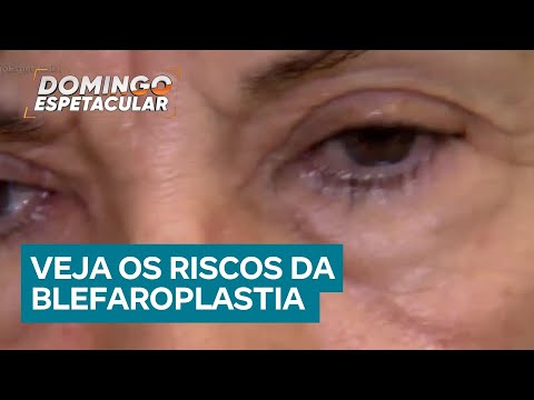 Blefaroplastia: conheça os riscos da cirurgia plástica mais realizada no mundo