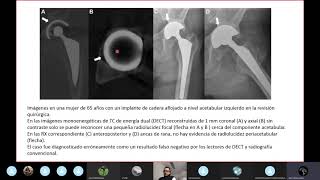 Aflojamiento doloroso de protesis cadera evaluación mediante dual TC