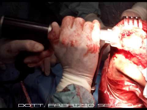 Come applicare Menovazin con dolore al collo Artropatia polso trattamento congiunto