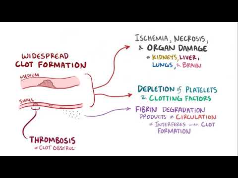 Disseminated intravascular coagulation   causes  symptoms  diagnosis  treatment  pathology