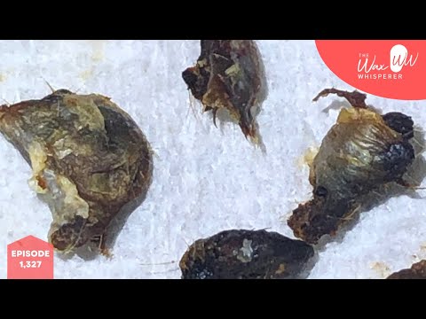 1,327 - Painful Referred Grade II Keratosis Obturans Removal