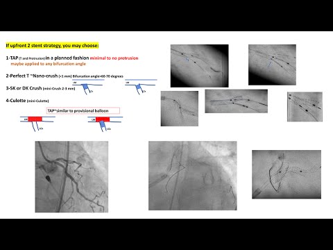 Bifurcation Left main part 2: case studies (2-stent techniques)