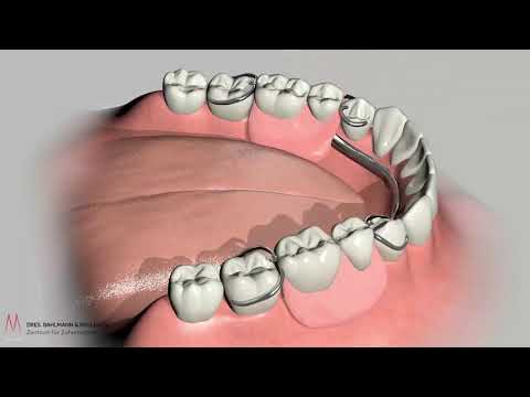 Was ist eine Modellgußprothese - Einfach erklärt Zahnarzt Köln