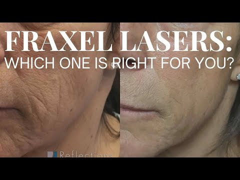 Which Fraxel Laser Is Best? Comparing the Different #FraxelLasers - There are 3!