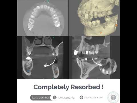 Resorption of Palatal Root of an Upper First Molar