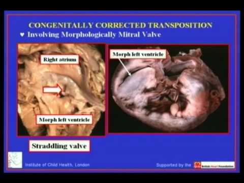 Congenitally corrected transposition of great arteries