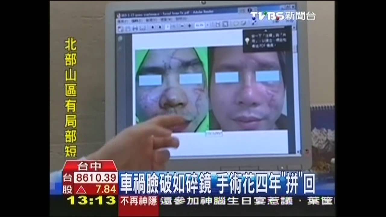 車禍臉破如碎鏡 手術花4年「拼」回
