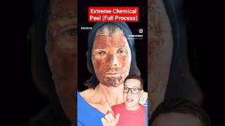 ALARMING CHEMICAL PEEL - Full Phenol Peel Process #shorts