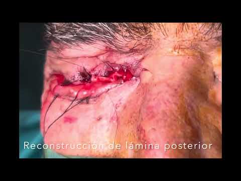 Tumor en cavidad anoftalmica