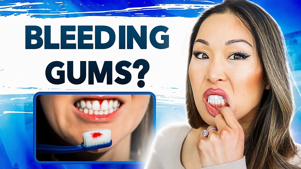 How to Treat Bleeding Gums