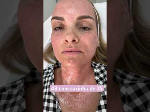 Morpheus: the procedure that rejuvenates