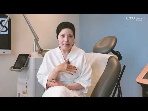 ULTRApulse Alpha – Scar Revision Patient Testimonial – Karina Lima