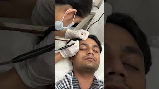 RF Cautery Treatment at Berkowits✨  #dermatologist #berkowitsclinic #skinclinic