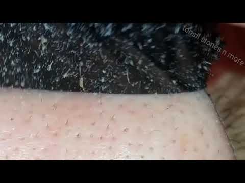 Olive Hair Mask opinii Po znieczuleniu zaczęła tracić włosy