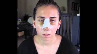 VLog of my Rhinoplasty Surgery, Recovery, #5