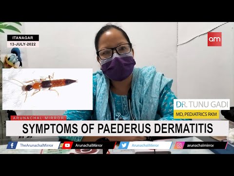 Symptoms of Paederus Dermatitis.