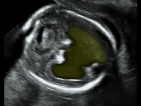 Fetal Medicine Foundation - Holoprosencephaly semilobar