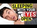Sleeping with Eyes Open - Dry Eye Treatments for Lagophthalmos