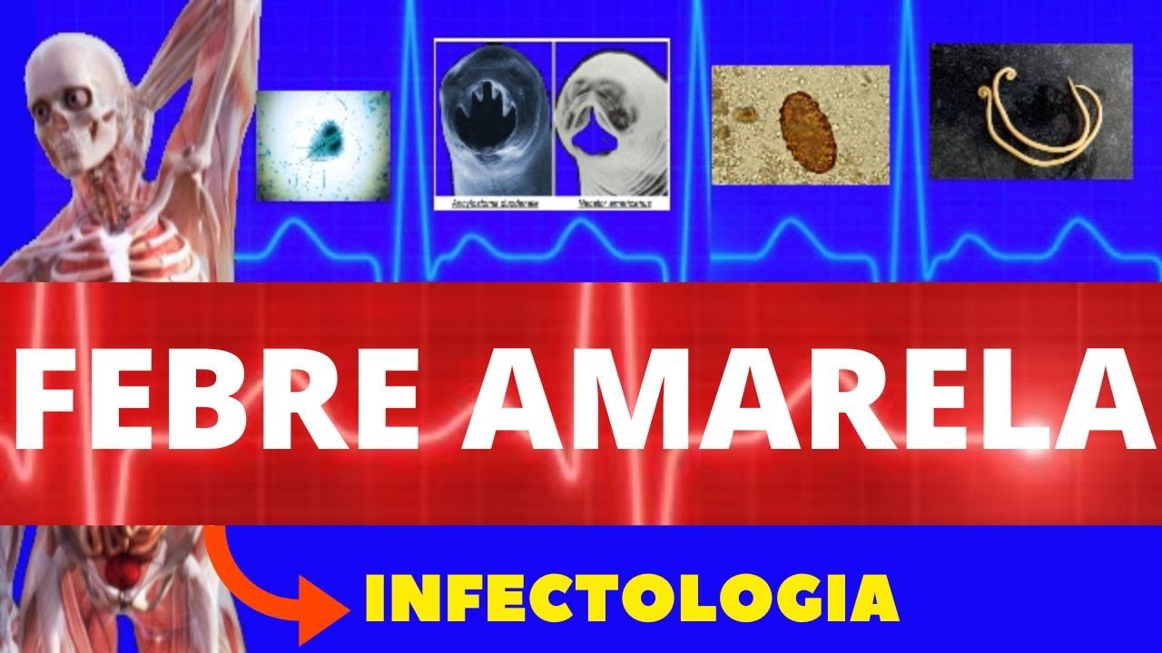 FEBRE AMARELA - CAUSAS, SINTOMAS, DIAGNÓSTICO E TRATAMENTO - INFECTOLOGIA - TUDO SOBRE FEBRE AMARELA