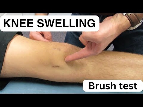 Modified Lachman s Test On a patient with a COMPLETE ACL TEAR