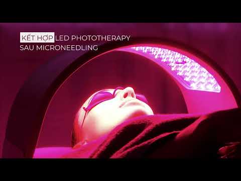 Microneedling kết hợp LED Phototherapy