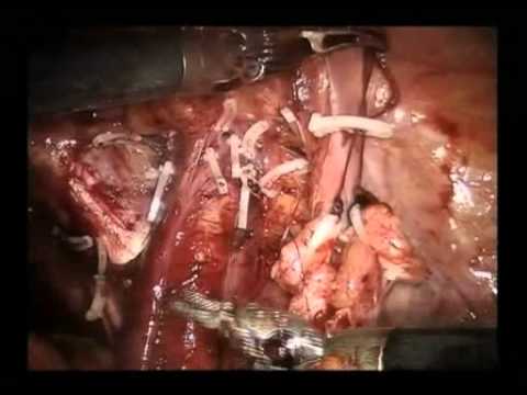 Radical Robotic Cystectomy With Intracorporeal Urinary Diversion - Part 2