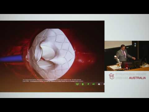 Initial experience with the Tendyne system - Prof Darren Walters