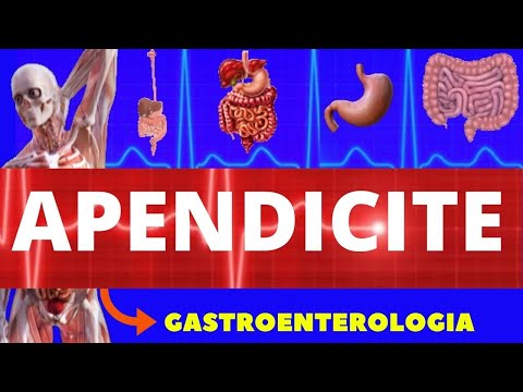 APENDICITE - CAUSAS, SINTOMAS, DIAGNÓSTICO E TRATAMENTO - APENDICITE AGUDA - DOR ABDOMINAL