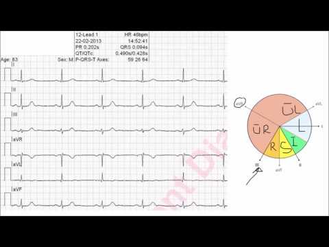 Bestimmung des Lagetyps (vereinfachte Methode mit Tabelle oder Cabrera Kreis)