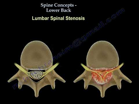 Lumbalstenose: Ursachen, Symptome und Behandlungsoptionen für Rückenschmerzen