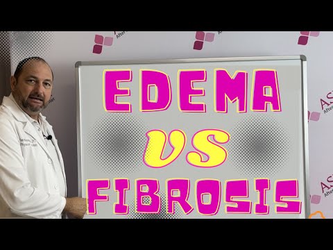 Edema VS Fibrosis- What's the Difference? Liposuction Contour Irregularity / Lipo Lumps and Bumps