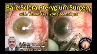 bare sclera pterygium surgery with tenon-free zone technique