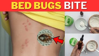 How To Get Rid Of Bed Bug Bites Overnight While You Sleep – Natural Home Remedy