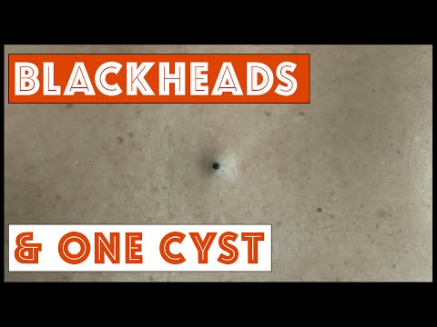 Blackheads and One Cyst