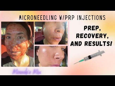 Microneedle w/PRP Eye Injections! Prep, Recovery & Results!