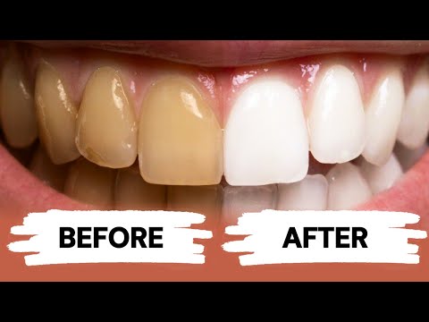 不用再花大把鈔票了！醫生教你在家就能無痛美白牙齒！ (Teeth Whitening at Home)