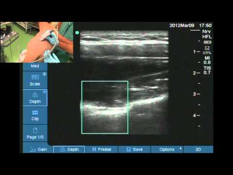 Suprascpular nerve block