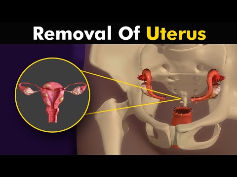 What happens in hysterectomy? Uterus Removal surgery animation