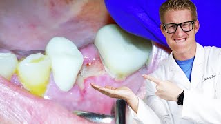 Dentist Explains TOOTH PAIN AFTER EXTRACTIONS! Throbbing, Dry Socket, & Aching For Days After