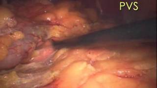 Laparoscopic low anterior resection for rectal cancer