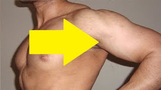how to get rid of stretch marks on shoulders naturally