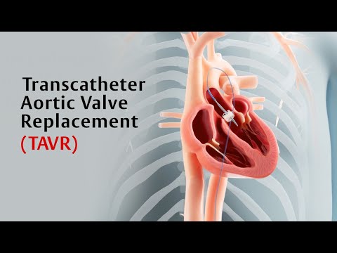 What Is the TAVR Procedure?