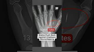 Would You Let Your Job Implant a Microchip in You?#ai #microchip #implant