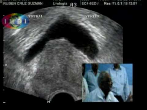 Sia la bicicletta è mostrato in adenoma prostatico Bagni prostata e radon