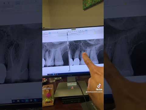 Overextended gutta percha! Endodontic retx of tooth #14 through a crown in one visit.