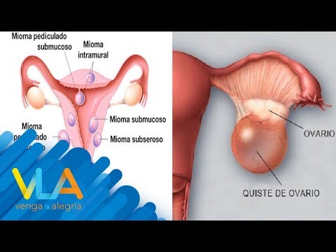 mioma látás mi ez prosztatagyulladás gyanúja esetén