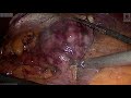 Laparoscopic lesser curve GIST Excision mp4
