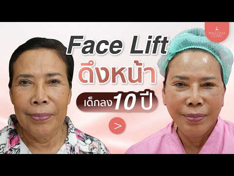 Face Lift เห็นกันชัด ๆ ดึงหน้าเด็กลง 10 ปี